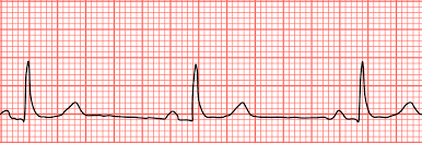 ACLS bradycardia algorithm